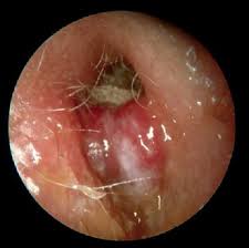 Malignant otitis externa - Hình ảnh minh họa